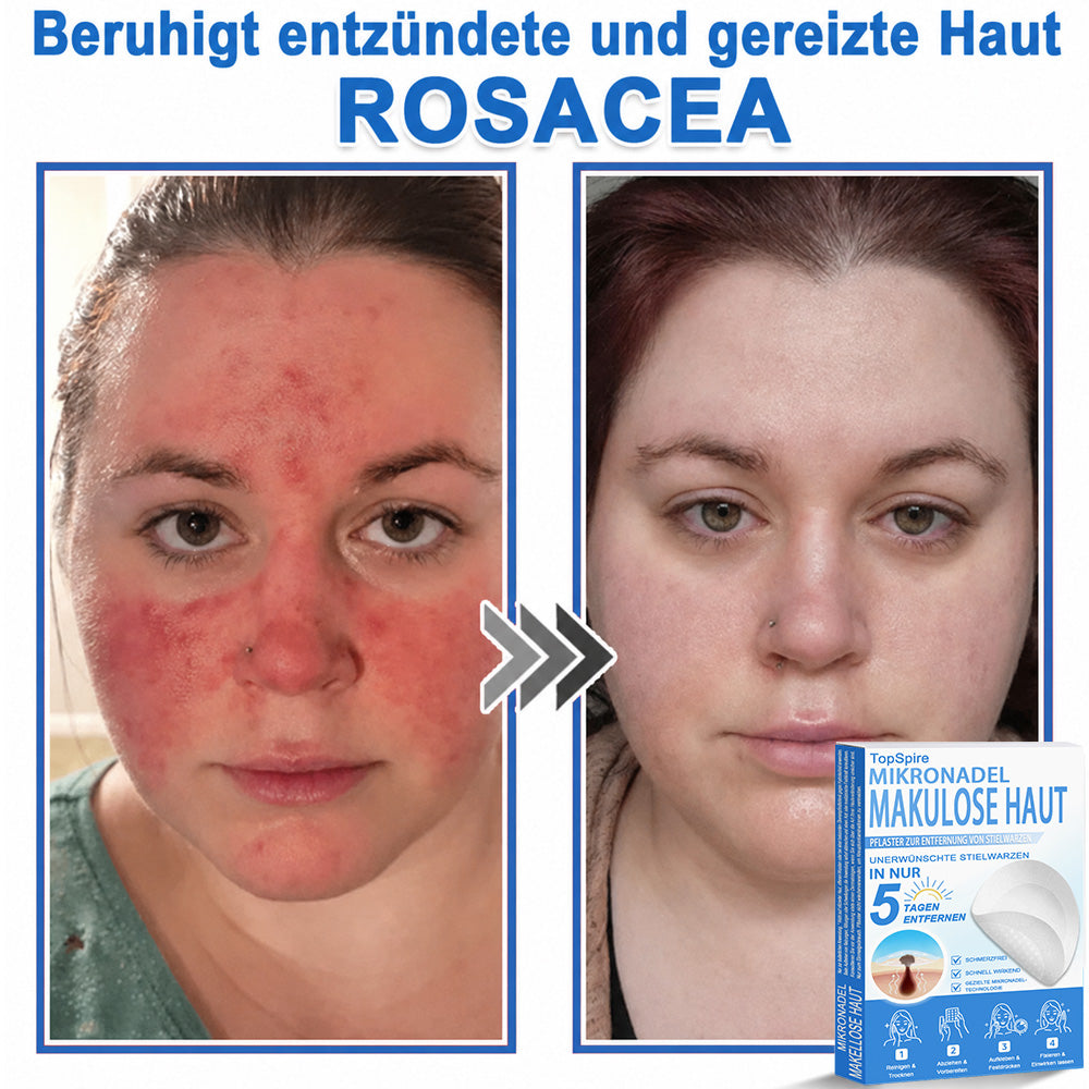 𝑻𝒐𝒑𝑺𝒑𝒊𝒓𝒆® 2-in-1 Mikronadel- & Hydrokolloid-Pflaster | Entferner für erhabene Muttermale, Akne, flache Warzen & Hautanhängsel | Verbessert Falten, Narben & Hautunreinheiten | Unsichtbare Stern-Pickelpflaster für Gesicht & Körper