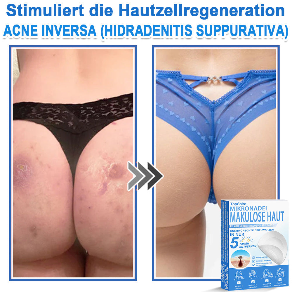 𝑻𝒐𝒑𝑺𝒑𝒊𝒓𝒆® 2-in-1 Mikronadel- & Hydrokolloid-Pflaster | Entferner für erhabene Muttermale, Akne, flache Warzen & Hautanhängsel | Verbessert Falten, Narben & Hautunreinheiten | Unsichtbare Stern-Pickelpflaster für Gesicht & Körper