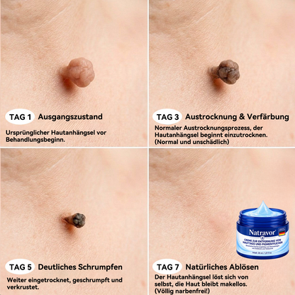 Natravor® 𝟕-𝐓𝐚𝐠𝐞 𝐇𝐚𝐮𝐭𝐚𝐧𝐡ä𝐧𝐠𝐬𝐞𝐥- & 𝐅𝐥𝐞𝐜𝐤𝐞𝐧-𝐄𝐧𝐭𝐟𝐞𝐫𝐧𝐮𝐧𝐠𝐬𝐜𝐫𝐞𝐦𝐞 (𝐒𝐜𝐡𝐦𝐞𝐫𝐳𝐟𝐫𝐞𝐢𝐞 𝐅𝐨𝐫𝐦𝐞𝐥 – 𝐨𝐡𝐧𝐞 𝐍𝐚𝐫𝐛𝐞𝐧)