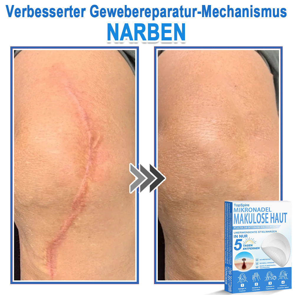 𝑻𝒐𝒑𝑺𝒑𝒊𝒓𝒆® 2-in-1 Mikronadel- & Hydrokolloid-Pflaster | Entferner für erhabene Muttermale, Akne, flache Warzen & Hautanhängsel | Verbessert Falten, Narben & Hautunreinheiten | Unsichtbare Stern-Pickelpflaster für Gesicht & Körper