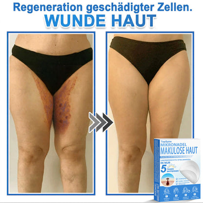 𝑻𝒐𝒑𝑺𝒑𝒊𝒓𝒆® 2-in-1 Mikronadel- & Hydrokolloid-Pflaster | Entferner für erhabene Muttermale, Akne, flache Warzen & Hautanhängsel | Verbessert Falten, Narben & Hautunreinheiten | Unsichtbare Stern-Pickelpflaster für Gesicht & Körper