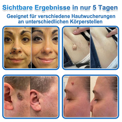 𝑻𝒐𝒑𝑺𝒑𝒊𝒓𝒆® 2-in-1 Mikronadel- & Hydrokolloid-Pflaster | Entferner für erhabene Muttermale, Akne, flache Warzen & Hautanhängsel | Verbessert Falten, Narben & Hautunreinheiten | Unsichtbare Stern-Pickelpflaster für Gesicht & Körper