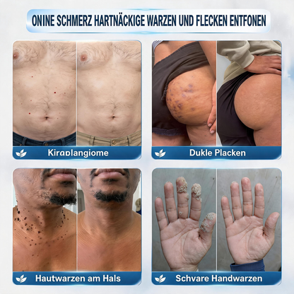 Natravor® 𝟕-𝐓𝐚𝐠𝐞 𝐇𝐚𝐮𝐭𝐚𝐧𝐡ä𝐧𝐠𝐬𝐞𝐥- & 𝐅𝐥𝐞𝐜𝐤𝐞𝐧-𝐄𝐧𝐭𝐟𝐞𝐫𝐧𝐮𝐧𝐠𝐬𝐜𝐫𝐞𝐦𝐞 (𝐒𝐜𝐡𝐦𝐞𝐫𝐳𝐟𝐫𝐞𝐢𝐞 𝐅𝐨𝐫𝐦𝐞𝐥 – 𝐨𝐡𝐧𝐞 𝐍𝐚𝐫𝐛𝐞𝐧)