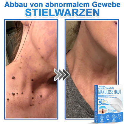 𝑻𝒐𝒑𝑺𝒑𝒊𝒓𝒆® 2-in-1 Mikronadel- & Hydrokolloid-Pflaster | Entferner für erhabene Muttermale, Akne, flache Warzen & Hautanhängsel | Verbessert Falten, Narben & Hautunreinheiten | Unsichtbare Stern-Pickelpflaster für Gesicht & Körper