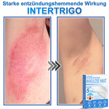 𝑻𝒐𝒑𝑺𝒑𝒊𝒓𝒆® 2-in-1 Mikronadel- & Hydrokolloid-Pflaster | Entferner für erhabene Muttermale, Akne, flache Warzen & Hautanhängsel | Verbessert Falten, Narben & Hautunreinheiten | Unsichtbare Stern-Pickelpflaster für Gesicht & Körper