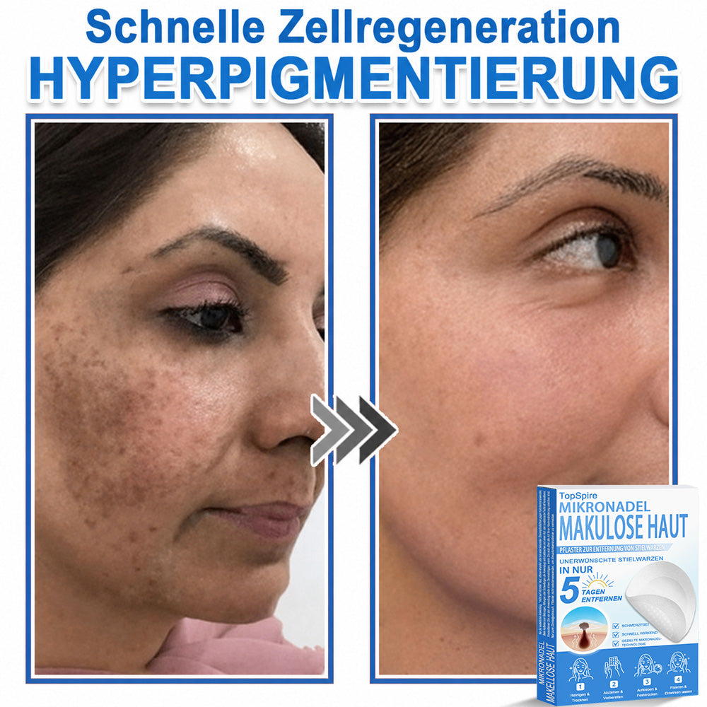 𝑻𝒐𝒑𝑺𝒑𝒊𝒓𝒆® 2-in-1 Mikronadel- & Hydrokolloid-Pflaster | Entferner für erhabene Muttermale, Akne, flache Warzen & Hautanhängsel | Verbessert Falten, Narben & Hautunreinheiten | Unsichtbare Stern-Pickelpflaster für Gesicht & Körper