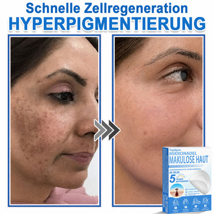 𝑻𝒐𝒑𝑺𝒑𝒊𝒓𝒆® 2-in-1 Mikronadel- & Hydrokolloid-Pflaster | Entferner für erhabene Muttermale, Akne, flache Warzen & Hautanhängsel | Verbessert Falten, Narben & Hautunreinheiten | Unsichtbare Stern-Pickelpflaster für Gesicht & Körper
