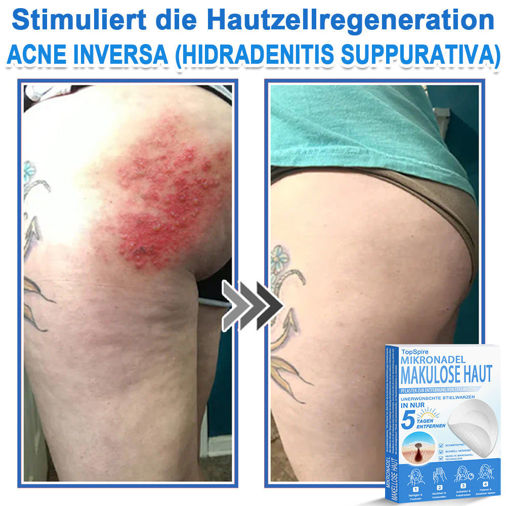𝑻𝒐𝒑𝑺𝒑𝒊𝒓𝒆® 2-in-1 Mikronadel- & Hydrokolloid-Pflaster | Entferner für erhabene Muttermale, Akne, flache Warzen & Hautanhängsel | Verbessert Falten, Narben & Hautunreinheiten | Unsichtbare Stern-Pickelpflaster für Gesicht & Körper