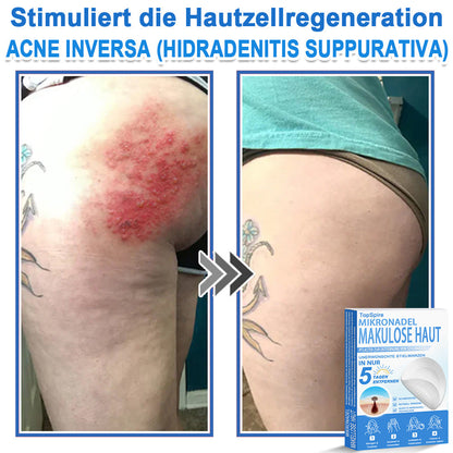 𝑻𝒐𝒑𝑺𝒑𝒊𝒓𝒆® 2-in-1 Mikronadel- & Hydrokolloid-Pflaster | Entferner für erhabene Muttermale, Akne, flache Warzen & Hautanhängsel | Verbessert Falten, Narben & Hautunreinheiten | Unsichtbare Stern-Pickelpflaster für Gesicht & Körper